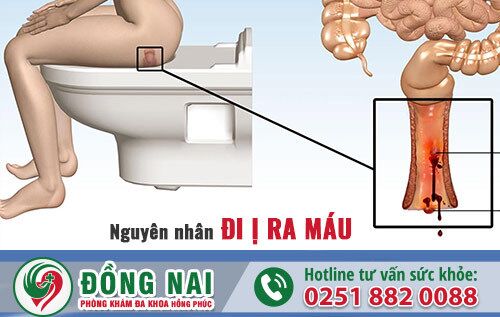 Nguyên nhân đi ị ra máu do đâu? Đi ị ra máu có sao không?