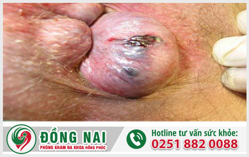 Nguyên nhân gây trĩ huyết khối và cách chữa trị tốt nhất
