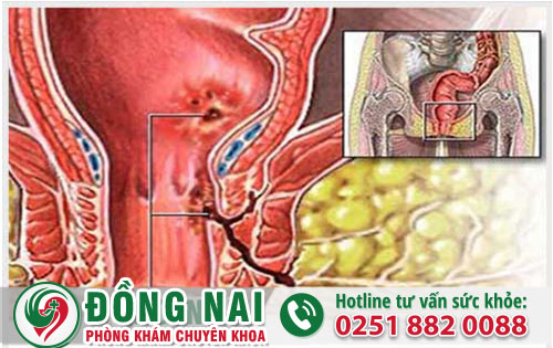 Nhiễm trùng hậu môn cảnh báo từ nhiều nguyên nhân bệnh