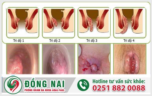 Những kiến thức cần biết về bệnh trĩ nội