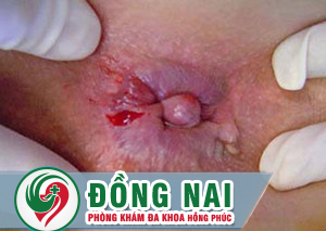 Nổi cục u hậu môn - Những biến chứng nguy hiểm và phương pháp hỗ trợ điều trị hiệu quả