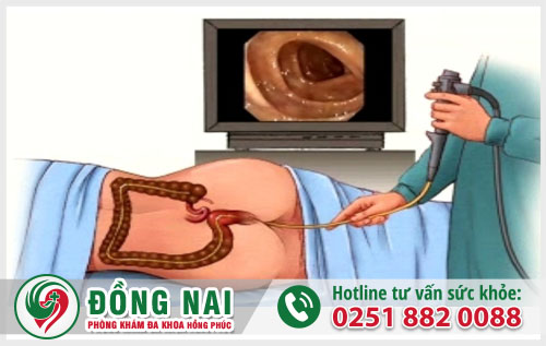Nội soi hậu môn bằng kỹ thuật nào hiệu quả?