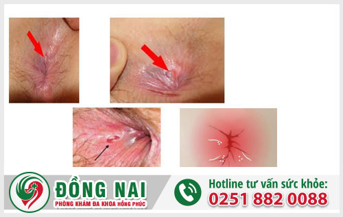 Nứt kẽ hậu môn – Bệnh hậu môn trực tràng nguy hiểm