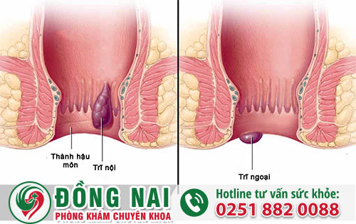 Hỗ trợ khắc phục bệnh trĩ nội trĩ ngoại với lá lốt