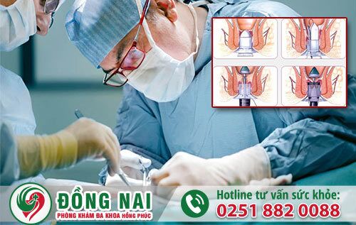Phẫu thuật cắt trĩ hiệu quả tốt nhất tại Biên Hòa, Đồng Nai