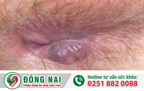 Phương pháp điều trị mụn hậu môn tại Biên Hòa