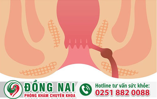 Rò hậu môn và những mối nguy hiểm ảnh hưởng sức khỏe bệnh nhân