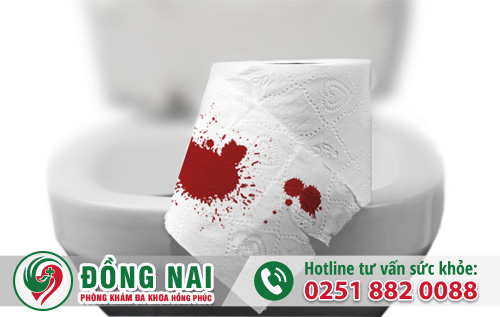 Sa búi trĩ là gì và cách xử lý như thế nào?