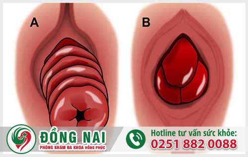 Sa Trực Tràng Do Đâu Và Ảnh Hưởng Đến Sức Khỏe Bạn Như Thế Nào?