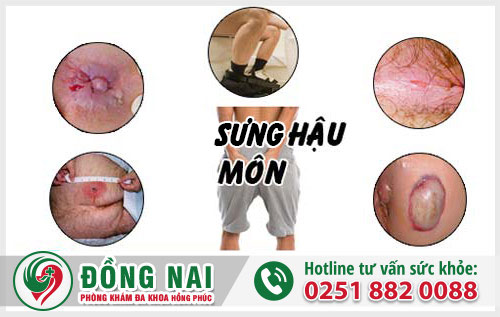 Sưng hậu môn là bệnh gì?