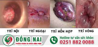 Sưng ngứa hậu môn là bệnh gì?
