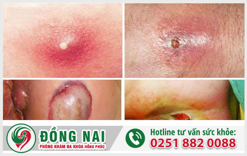 Sưng ngứa hậu môn là bệnh gì?