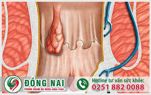 Tại Sao Hậu Môn Lại Bị Tiết Dịch Nhầy?