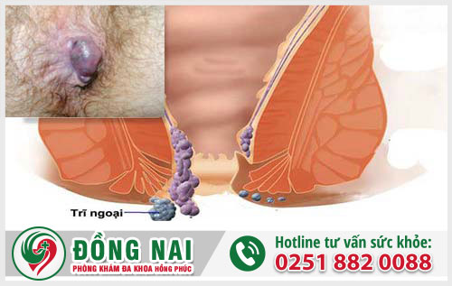 Tất tần tật về bệnh trĩ tắc mạch