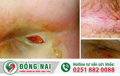 Tét rách hậu môn là bệnh gì?