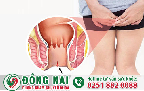 Thuốc hỗ trợ khắc phục nứt kẽ hậu môn nào tốt hiện nay?