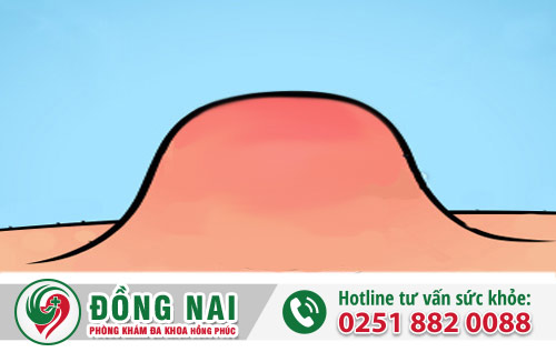 Tìm hiểu về chứng khối u hậu môn