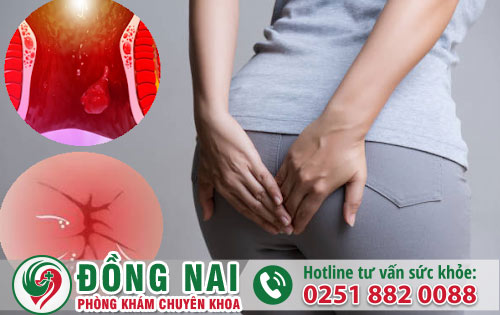 Tình trạng xuất hiện vật thể lạ hậu môn cảnh báo bệnh gì?