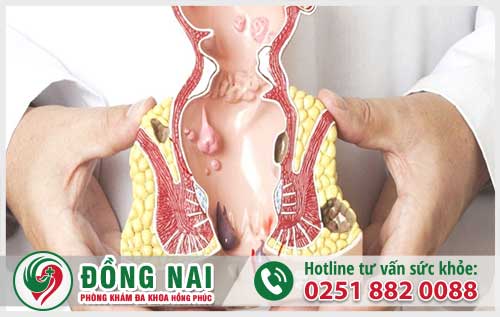 Trĩ Hỗn Hợp Là Gì? Có Mấy Loại Trĩ Thường Gặp Hiện Nay