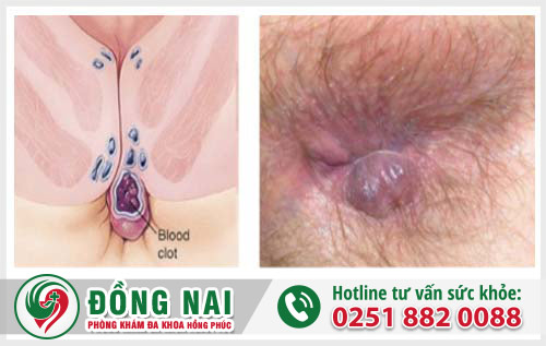 Trĩ huyết khối – dấu hiệu và cách điều trị
