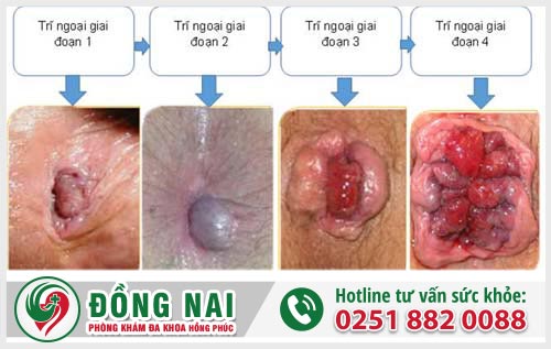 Trĩ ngoại là gì?