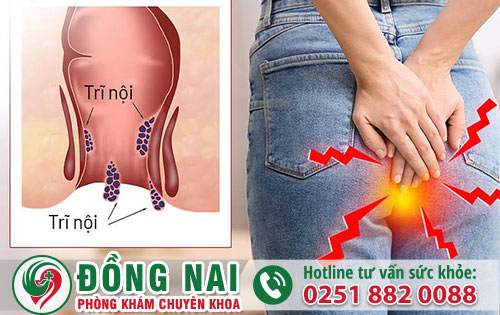 Trĩ nội bắt nguồn từ những yếu tố nào để gây bệnh?