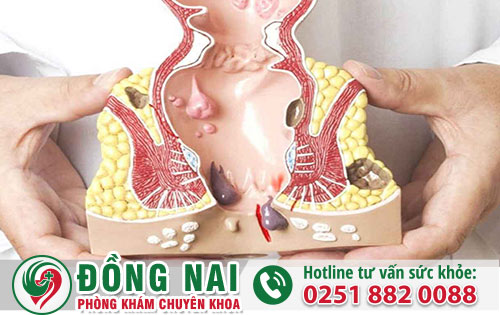 Trĩ nội gây ra không ít các biến chứng nguy hiểm mà bạn cần biết