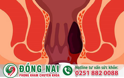 Trĩ nội: nguyên nhân, triệu chứng và cách điều trị