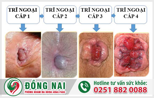 Trĩ nội và trĩ ngoại cái nào nặng hơn?