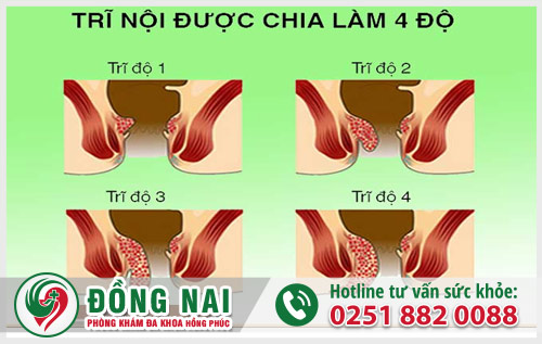 Triệu chứng bệnh trĩ và cách điều trị hiệu quả