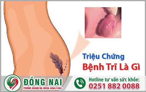 Triệu chứng bệnh trĩ là gì? Nguyên nhân và cách chữa trị hiệu quả