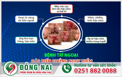 Trĩ ngoại gây ra nhiều biến chứng nguy hiểm nếu không điều trị sớm