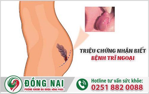 Bệnh trĩ ngoại cần được phát hiện và điều trị sớm